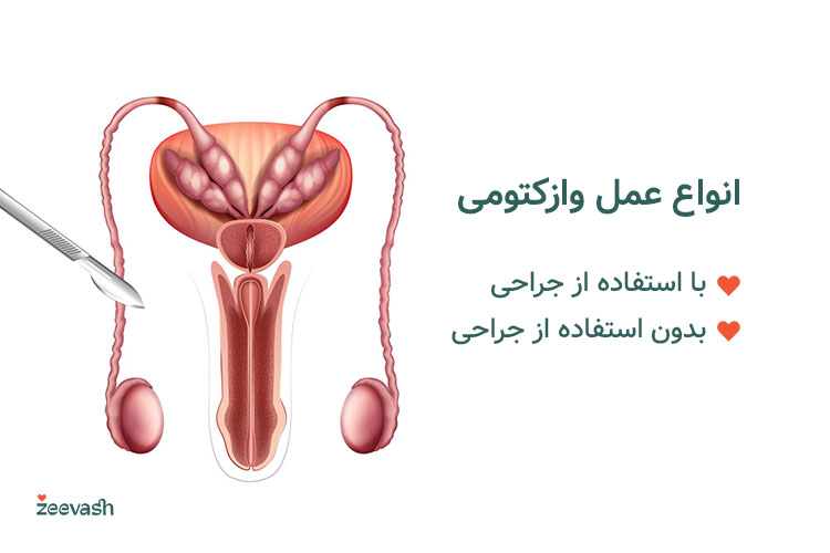 انواع عمل وازکتومی با جراحی و بدون جراحی است.